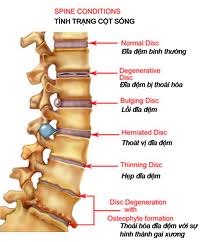 GIÁC HƠI TRỊ BỆNH THOÁI ĐĨA ĐỆM CỘT SỐNG LƯNG