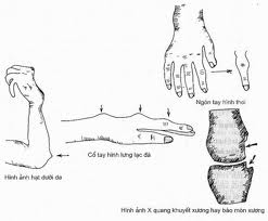 Massage bấm huyệt chữa Đau khớp cổ tay